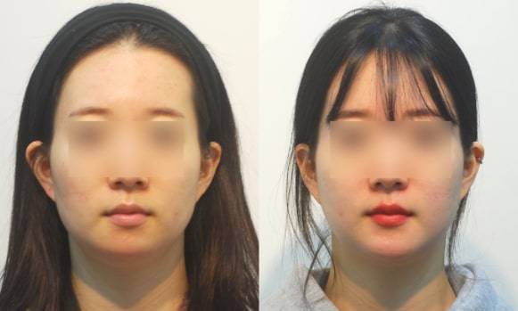 이전 수술로 턱끝을 너무 줄여 턱이 뭉뚝해졌다. 다시 늘여주는 수술로 얼굴형이 호전됐다.