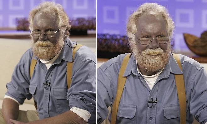 현실판 스머프…은이온수 섭취 후 ‘파란색 피부’ 된 남자 / 사진=NBC 방송