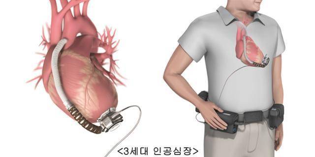 제3세대 좌심실 보조 장치(LVAD). 서울아산병원 제공