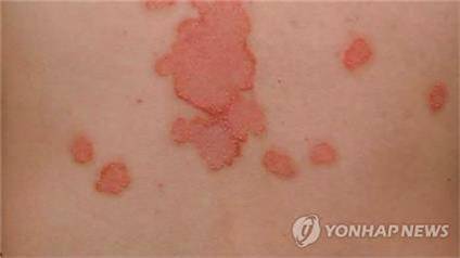 건선 연합뉴스 TV 캡처: 작성 김선영(미디어랩)