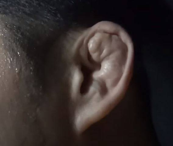 SBS 예능프로그램 '가로채널'에 출연한 이종격투기 선수 김동현(41)이 이개혈종으로 변형된 자신의 귀를 공개했다. 이개혈종을 방치하면 귀가 변형되거나 주변 피부가 괴사할 수 있다./사진=유튜브 채널 SBS Entertainment 캡처