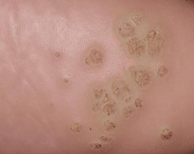 발바닥 사마귀 모습. 사진제공=Thomas Habif