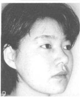 사각부위를 잘라내서 생긴 '개턱'의 느낌, 하지만 오늘날엔 이런 구식 수술이 거의 시행되지 않습니다. Aesthetic Plastic Surgery volume 19,93(1995)