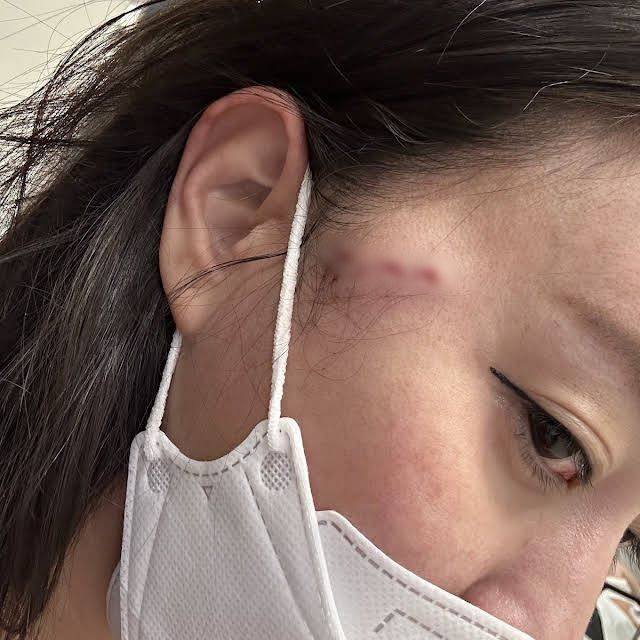 경기 부천시 부천역 인근 길거리에서 동료 BJ에게 포크로 공격당한 감성여울이 상처 부위를 찍은 사진을 공개했다. /유튜브 감성여울