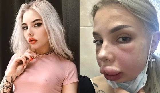 러시아에서 입술 축소 수술을 받은 20대 여성이 항염제 부작용으로 입술과 뺨이 크게 부어오르는 일이 발생했다. 사진 데일리메일 캡처