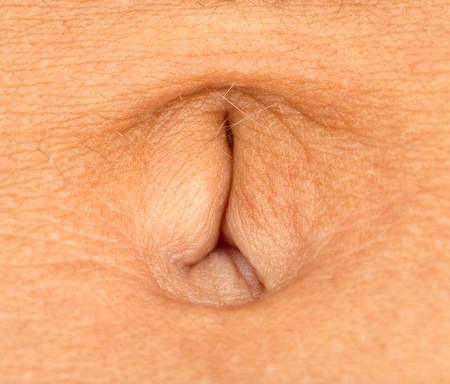 배꼽탈장은 초기에 특별한 통증이 나타나지 않아 그대로 내버려 두는 경우가 많다./사진=게티이미지뱅크