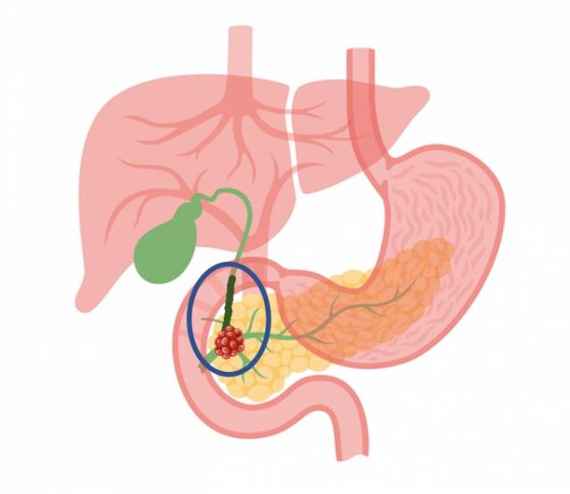 췌장에 생긴 종양이 담관을 막아 담즙이 정체된 모습. 사진 제공=한림대의료원