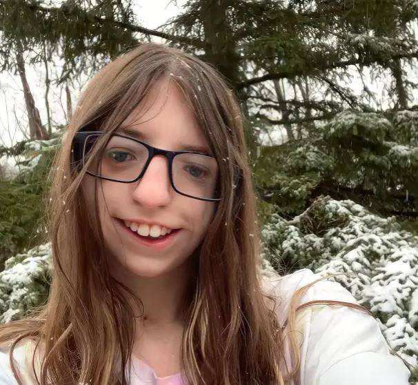 트리처 콜린스 증후군을 앓고 있는 아나 크리자노프스키의 모습./사진=더 선 캡처