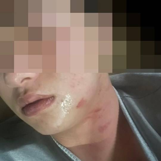 <사진 설명> 샌디에이고 김하성이 공갈 혐의로 경찰에 고소한 후배 야구선수 A씨. 폭행 직후 본인이 남겨 놓은 사진. (사진: A씨 변호인)