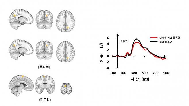 기능적 MRI 검사 결과 인터넷 게임 중독군은 정상 대조군보다 두정엽과 전두엽 부위에서 뇌 활성이 증가했다.(왼쪽) 청각 자극에 대한 뇌파 신호의 진폭은 인터넷 게임 중독군이 대조군보다 감소했다. 삼성서울병원 제공.