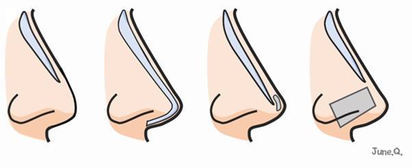 하늘색은 보형물, 회색은 연골을 나타냅니다.