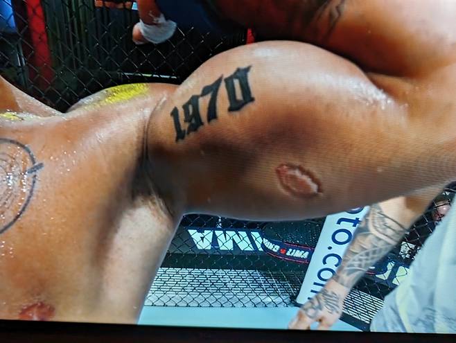 이고르 세베리누가 물어뜯은 안드레 리마의 왼팔. 사진=UFC 공식 SNS