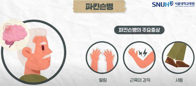파킨슨병 주요 증상. 서울대병원 제공