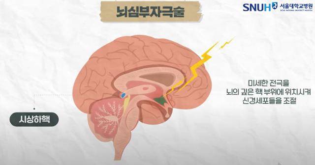 뇌심부자극술. 서울대병원 제공