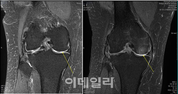 실제 카티라이프 수술을 받은 환자의 무릎을 MRI 촬영한 사진. 왼쪽 수술 전 사진을 보면 뼈(검정색)를 둘러싸고 있는 얇은 막처럼 보이는 연골(회색)이 벗겨서 뼈가 노출됐고 그 공간으로 물(흰색)이 차 있다. 오른쪽 수술 후 사진을 보면 뼈 주위로 연골이 재생이 돼 노출된 뼈(검정색) 표면의 빈 공간이 사라졌다.(제공= 흥케이병원)