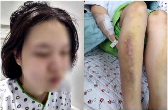 전 남자친구에게 폭행 당해 전치 6주 부상을 입고 입원했을 당시 피해자의 모습. JTBC 보도화면 캡처