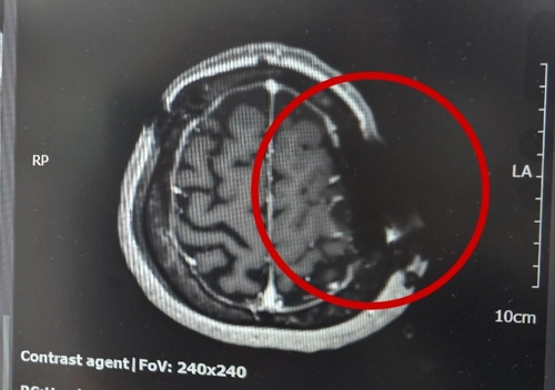 동그라미 부근의 머리뼈에 쇠톱 날이 박혀 자기공명영상(MRI)이 제대로 찍히지 않았다. MRI는 자기공명을 이용하는데 금속 물질이 있어 정상적으로 작동하지 않았다고 한다. [연합뉴스]