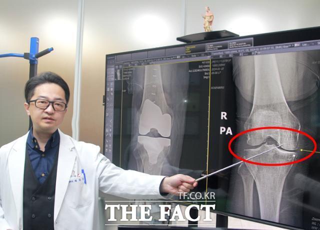 배상근 정형외과 전문의가 퇴행성 관절염으로 인해 연골이 닳아 수술이 필요한 관절(오른쪽)의 X-레이 사진을 보여주고 있다./대구 백두병원