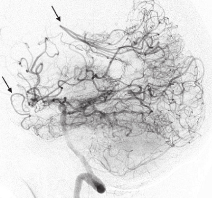 모야모야병 환자의 뇌혈관 모습. Gemelli NA.
