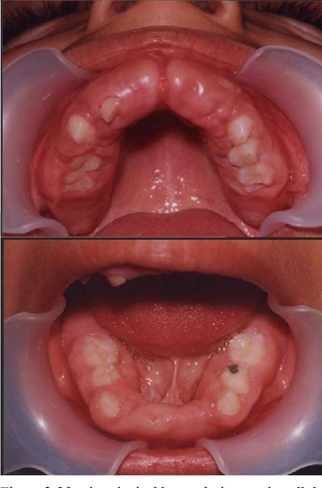 지머맨-레이밴드 증후군이 있으면 잇몸이 과도하게 성장하는 ‘치은섬유종증(gingival fibromatosis)’이 나타난다.​/사진=Journal of Periodontology & Implant Dentistry