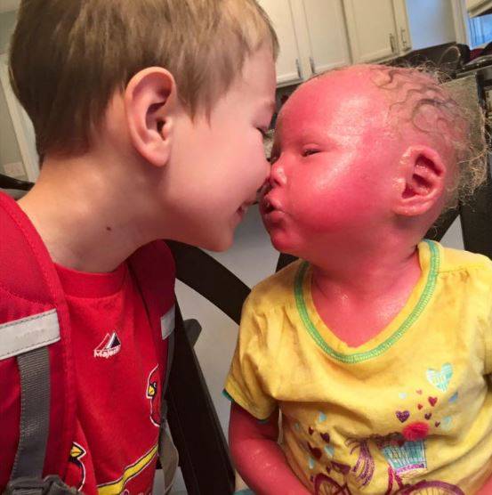 미국 일리노이주에 사는 브리에나는 할리퀸 어린선 때문에 지난 2011년 태어나자마자 온몸의 피부가 두꺼운 피부 각질로 뒤덮인 채 빨갛게 퉁퉁 부어있었다. 브리에나와 오빠 커너의 사진./사진=BlessedByBrenna