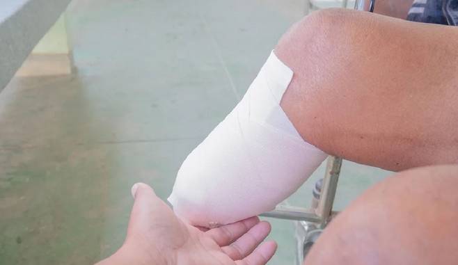 신체통합정체성장애는 신체 일부가 장애가 되기를 스스로 원하는 정신질환이다./사진=CNN