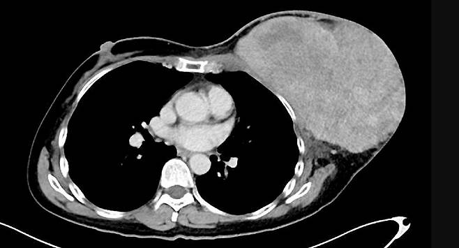 가슴에 엽상종이 발생하면서 한쪽 유방이 과도하게 커진 환자의 CT 사진./사진=국제외과저널사례보고