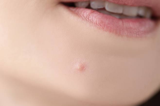 겉보기엔 여드름 같아도 잘 짜지지 않는다면 표피 낭종일 수 있다./사진=게티이미지뱅크
