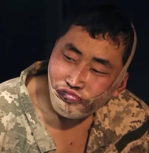 붕대를 감고 있는 또 다른 북한군의 모습/사진=스래드(SNS) 갈무리