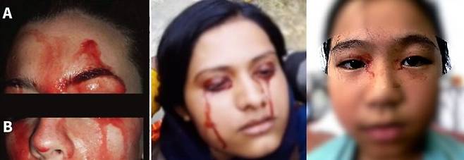 얼굴과 손바닥 등에서 피가 섞인 땀을 흘리는 '혈한증'에 걸린 환자들. 29 이탈리아 여성, 눈에서 피땀이 흐르는 인도 여성 지타, 태국 소녀 농카이(왼쪽부터)