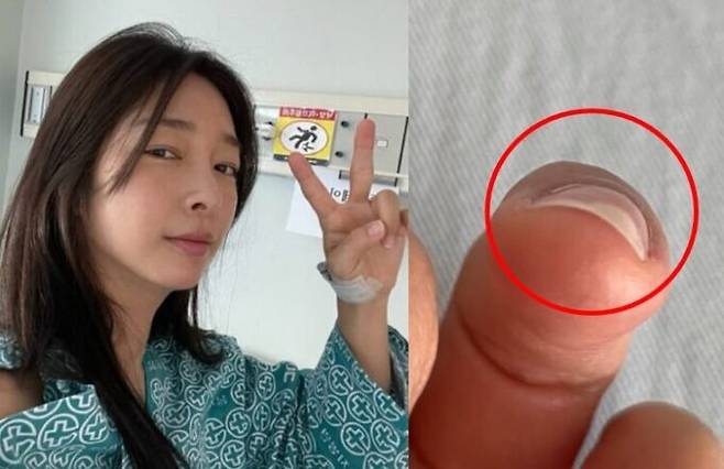 그룹 익스 출신 가수 이상미가 사구체종 수술을 받았다고 말했다. 이상미 SNS 캡처