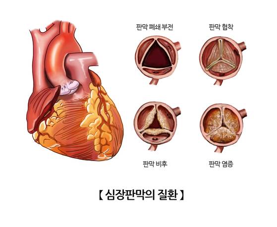 심장판막 질환 관련 이미지. 서울아산병원