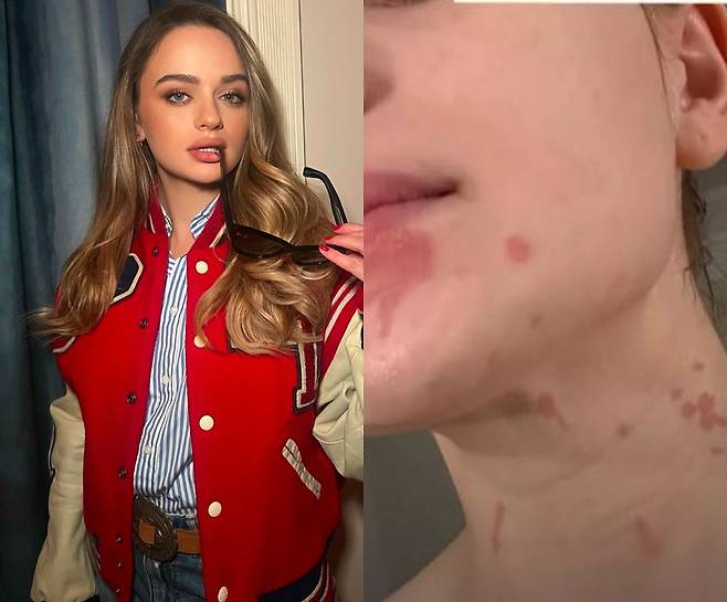 넷플릭스 인기 오리지널 시리즈 ‘키싱부스’로 이름을 알린 미국 배우 조이 킹(25)이 요리 중 화상을 입었다고 전했다./사진=조이 킹 SNS