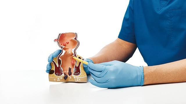 치핵은 증상과 정도에 따라 치료 방법이 달라진다|출처: 클립아트코리아