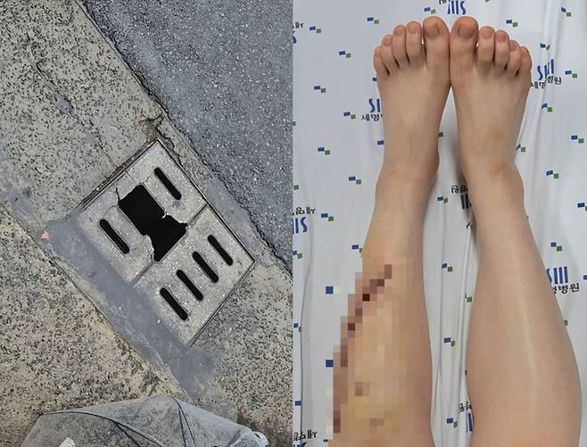 깨진 하수구 뚜껑에 발이 빠져 넘어진 A씨가 무릎과 발목 사이 피부가 크게 찢어지는 부상을 당해 24바늘을 꿰매는 수술을 받았다. /사진=인스타그램 갈무리