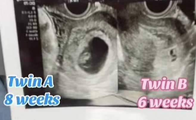 미국에서 20대 여성이 중복임신 됐다고 밝혀 화제다. 사진은 테일러 헨더슨이 자신의 SNS를 통해 공개한 중복임신 태아 초음파 사진. /사진=테일러 헨더슨 SNS 캡처