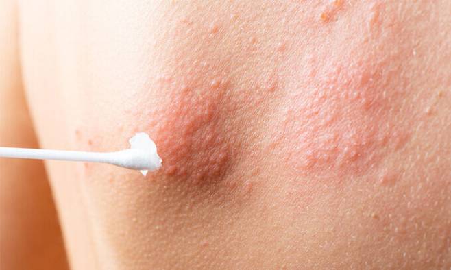 아밀로이드 PET 영상. 왼쪽처럼 알츠하이머 치매 환자에서는 뇌피질 부위에 아밀로이드 침착으로 붉은 색깔(화살표)로 보이게 된다. 정상인은 뇌피질 부위에 아밀로이드 침착이 없음을 볼 수 있다(오른쪽).