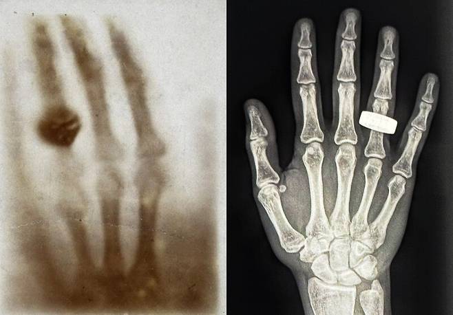 프램2 탐사대원들은 우주에 있는 동안 엑스선 촬영(오른쪽)을 했다. 우주에서 인체 엑스선 사진을 찍은 것은 130년만에 처음이다. 왼쪽은 최초의 엑스선 사진. 스페이스엑스 제공