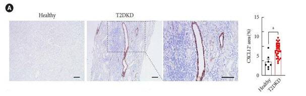 당뇨병콩팥병(T2DKD)과 건강한 신장 조직 비교: 당뇨병콩팥병 조직에서는 CXCL12 발현이 증가하며, 특히 T 면역세포가 많이 침투된 부위에서 강하게 나타남. 오른쪽 그래프는 당뇨병콩팥병 환자 그룹이 건강한 그룹에 비해 CXCL12 신장 발현이 증가함을 보여줌. 이는 CXCL12가 당뇨병콩팥병 환자의 신장 염증 진행에 중요한 역할을 한다는 것을 시사함.