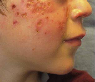 얼굴에 우두모양물집증이 발생한 모습/사진=Hematology and Coagulation