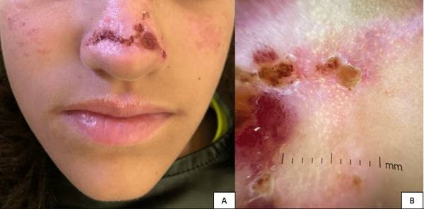 피부에 우두모양물집증이 발생한 모습/사진=Cureus