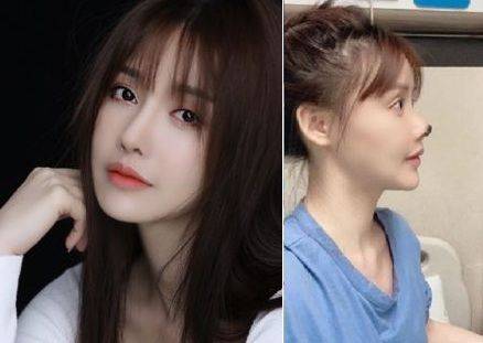 성형수술 전 가오 류 사진과 수술 부작용이 나타난 사진. 출처=데일리메일