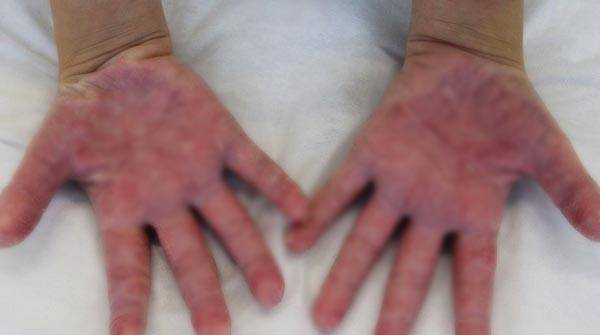 장난감을 가지고 놀았다가, 손 전체가 붉어지고 피부가 벗겨지는 등 알레르기 증상을 겪은 사례가 공개됐다./사진=스페인 피부과학회 저널