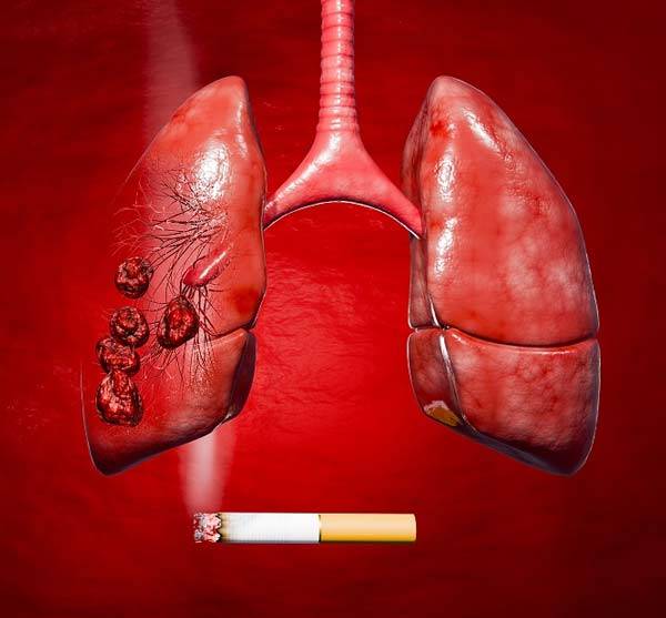 하루 한 갑씩 30년 넘게 담배를 피운 사람은 비흡연자보다 소세포폐암에 걸릴 가능성이 최대 54배까지 높다는 연구 결과가 나왔다. /사진=게티이미지뱅크