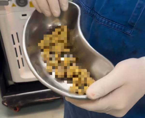 브라질의 한 60대 남성이 탄산음료를 즐겨 마시다가 방광에서 수십 개의 결석이 발견돼 사연이 공개돼 화제다./사진=니드투노우