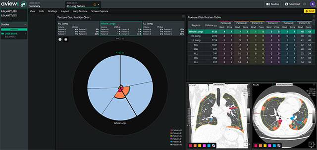 AVIEW Lung Texture 이미지. 사진제공=코어라인소프트