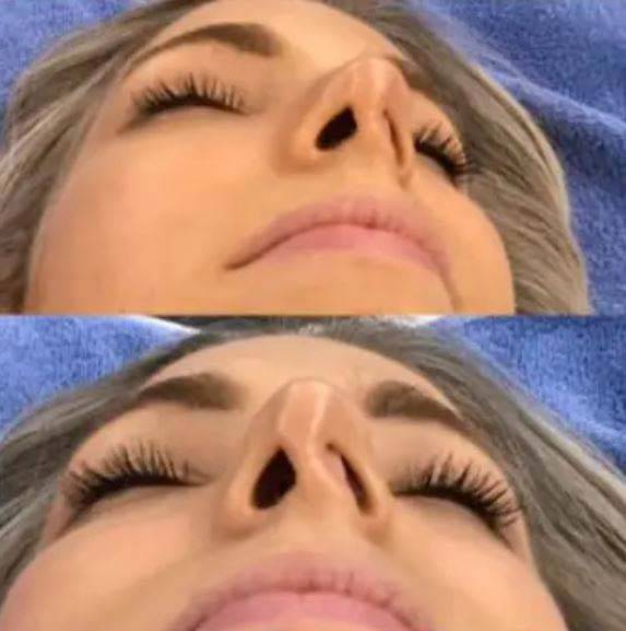 한 30대 여성이 코 성형수술을 받은 뒤 코 한쪽이 무너진 사연이 공개됐다./사진=뉴욕포스트