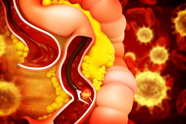 운동이 암의 재발이나 사망위험을 낮춰준다는 연구결과가 나왔다. 사진은 기사의 특정 사실과 관련 없음. 게티이미지뱅크