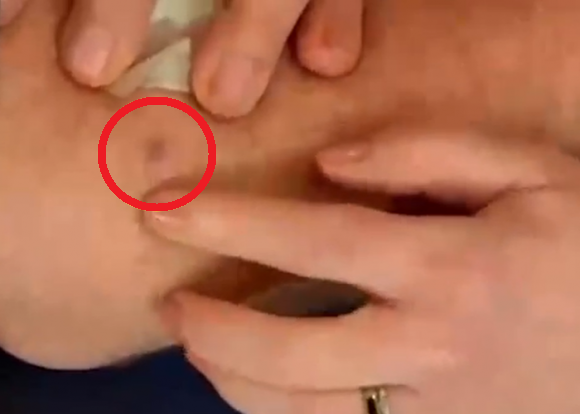 피부과 전문의가 폭스29의 ‘굿 데이 필라델피아’ 진행자인 마이크 제릭의 팔꿈치 부위에 있는 반점(빨간색 원)을 가리키고 있다. 폭스29 방송 화면 캡처