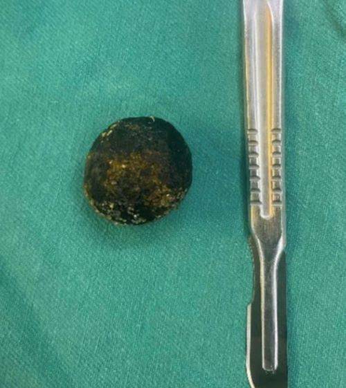 A씨의 몸에서 제거된 2.5cm의 담석./사진=자딘 닷 베트남